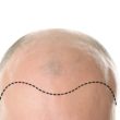 Benefits of FUE Hair Transplant Surgery