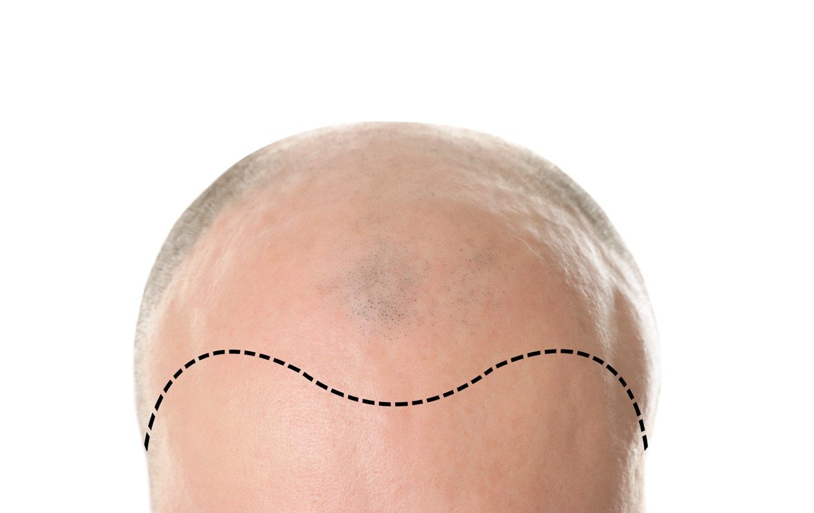 Benefits of FUE Hair Transplant Surgery