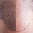 Importance of an Experienced Hair Transplant Surgeon