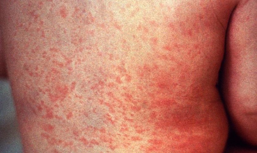 What Is the Danger of Measles and How to Protect Yourself