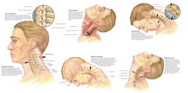 Everything you need to know about whiplash injuries