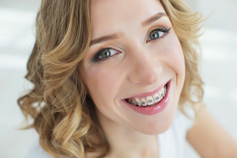 Have You Heard of Accelerated Orthodontics? You Should Have!