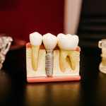 Dental Implant And Crown