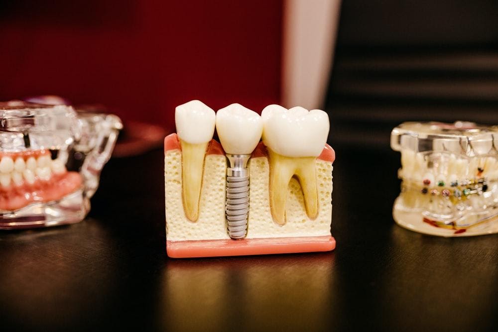 Dental Implant And Crown: All You Need To Know