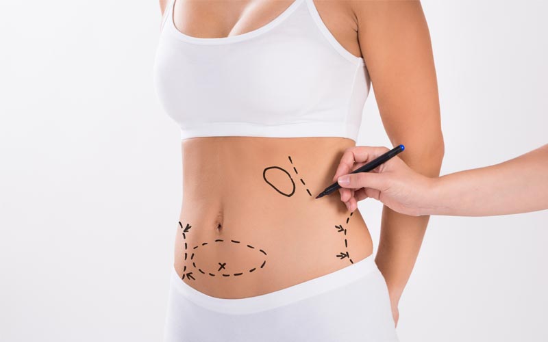 Are You a Good Candidate for Liposuction?